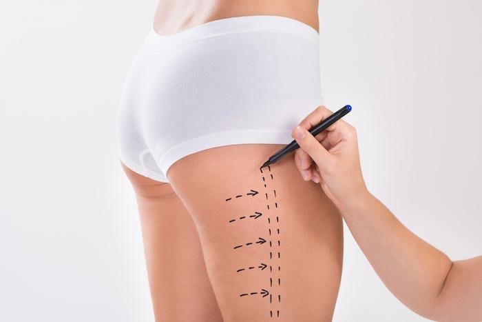 Full Body Liposuction in Dubai The Role of Technology in Lipo Surgery