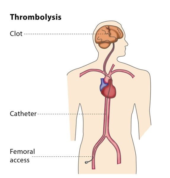 Understanding the Thrombolysis Procedure: A Key to Effective Treatment