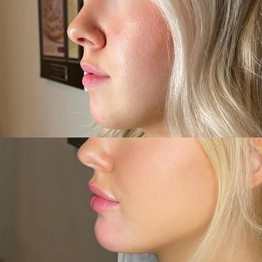 Define Your Chin with Professional Chin Fillers Treatment in Dubai