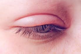 The Impact of Allergies on Eye Inflammation and How to Manage It